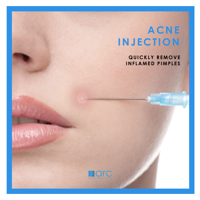 ACNE INJECTION